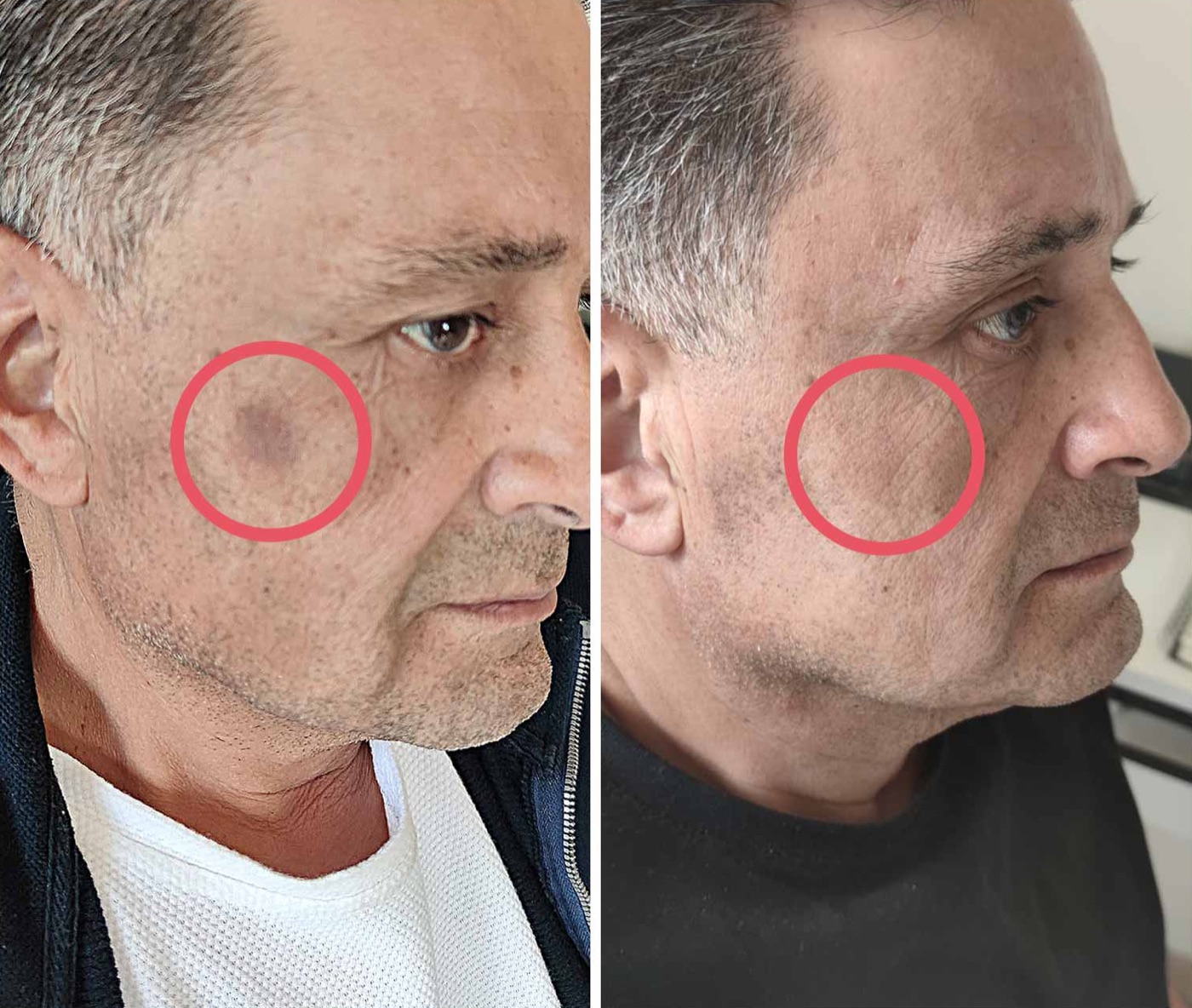 A man’s cheek with a pigment spot circled in red: before on the left, after using Avush on the right
