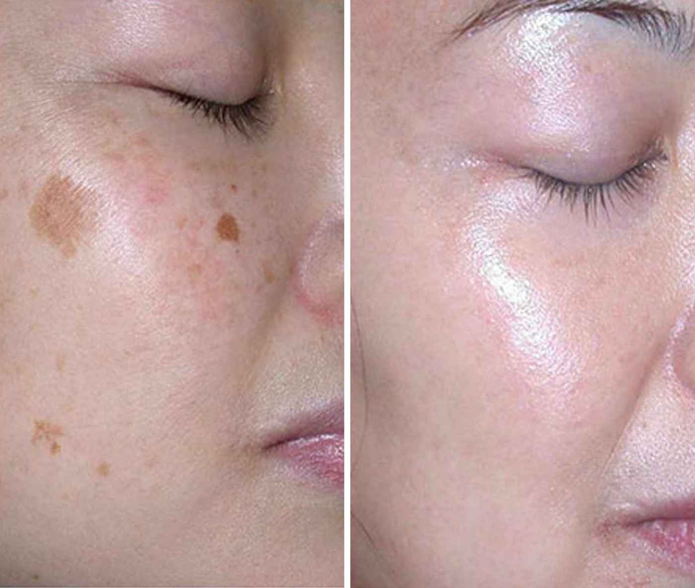 A woman’s cheek with pigment spots: before on the left, after using Avush on the right