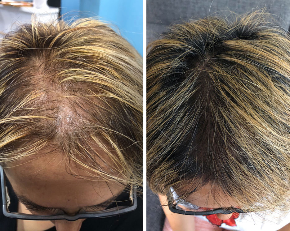Naisen jakaus, 45 vuotta: vasemmalla ennen, oikealla 5 kuukauden LADUTI Hair Serum -käytön jälkeen