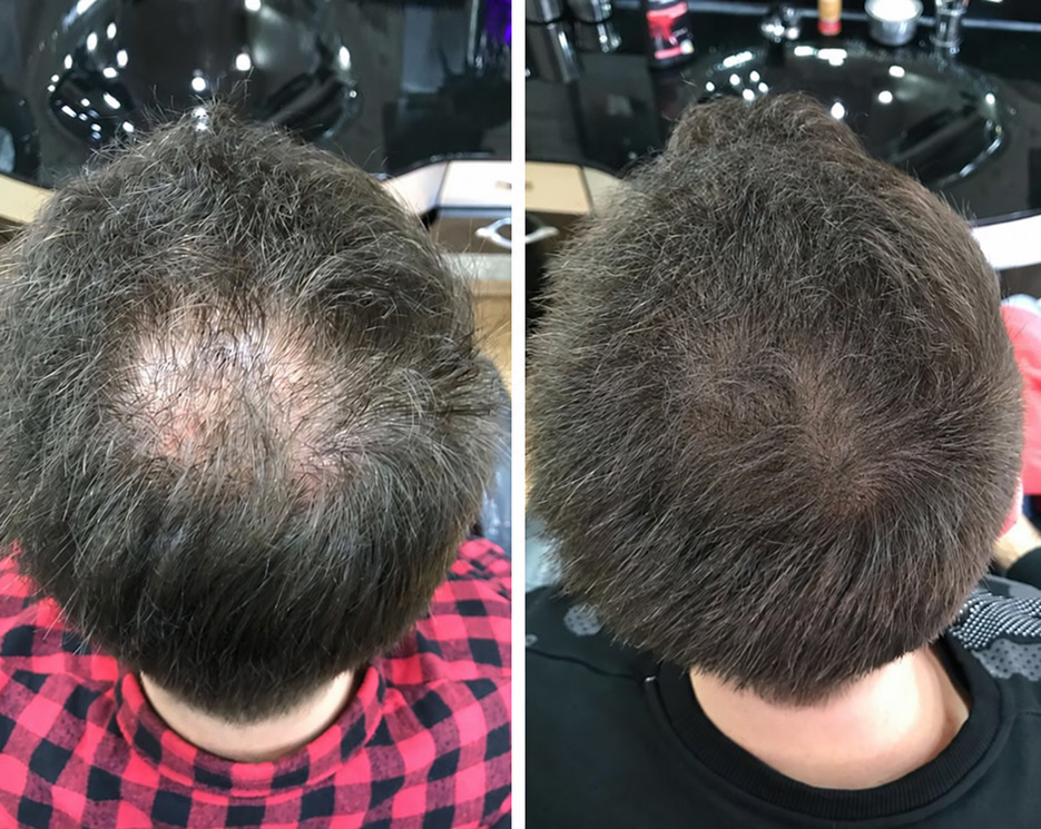 Miehen päälaki, 31 vuotta: vasemmalla ennen, oikealla 4 kuukauden LADUTI Hair Serum -käytön jälkeen