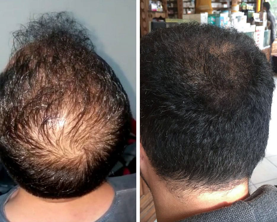 Miehen päälaki, 42 vuotta: vasemmalla ennen, oikealla 5 kuukauden LADUTI Hair Serum -käytön jälkeen