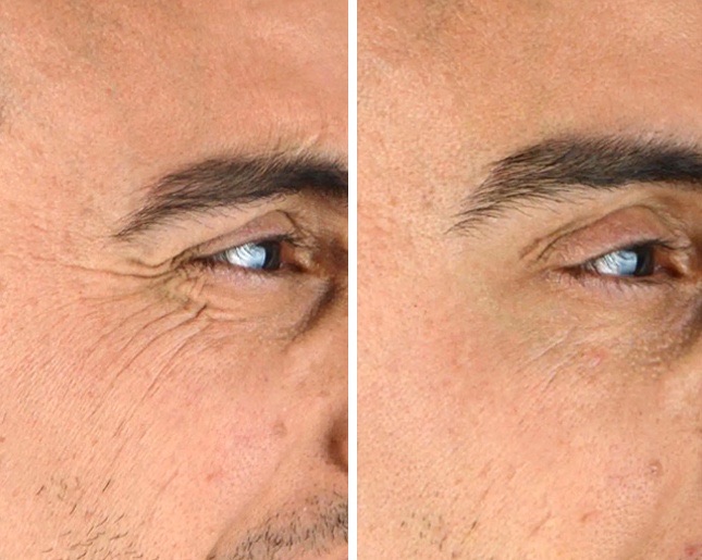 Zona occhi con rughette: a sinistra prima, a destra dopo Lavuj Retinol Serum