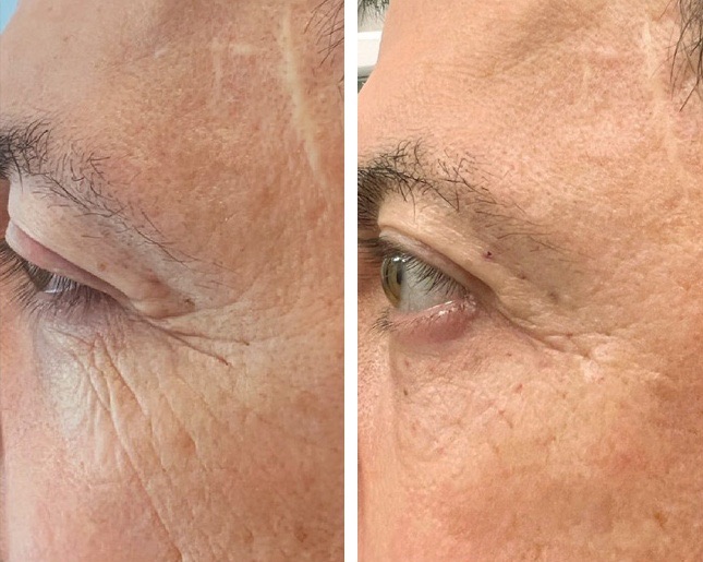 Zona occhi: a sinistra prima, a destra dopo Lavuj Retinol Serum
