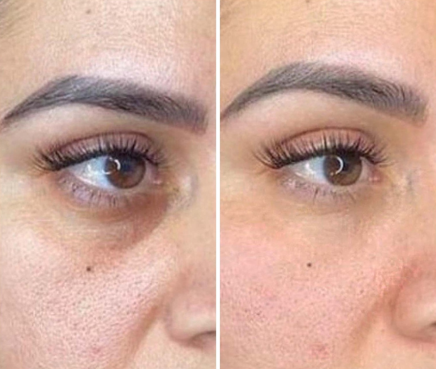 Зона около окото на жена: вляво преди с тъмен кръг, вдясно след Lavule Eye Serum (снимка: lavule.com)