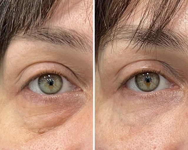 Зона около окото: вляво преди с подпухване и сянка под окото, вдясно след Lavule Eye Serum (снимка: lavule.com)