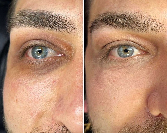 Зона около окото на мъж: вляво преди със сянка под окото, вдясно след Lavule Eye Serum (снимка: lavule.com)