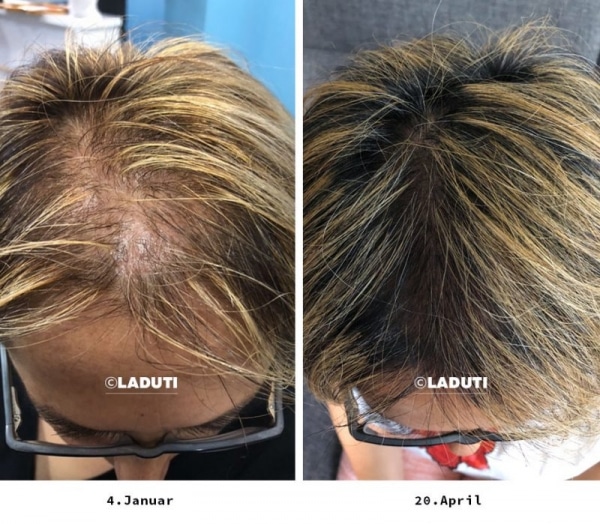 Das Hilft Bei Kreisrundem Haarausfall Schwarzkopf Das Hilft Bei Kreisrundem Haarausfall Schwarzkopf