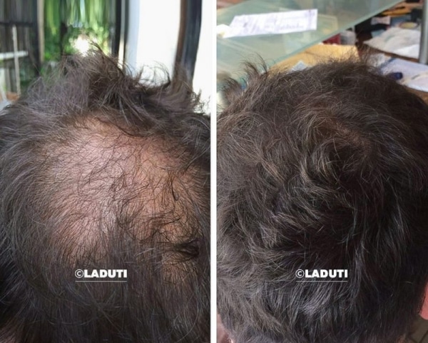 Mittel-gegen-Haarausfall Mittel-gegen-Haarausfall