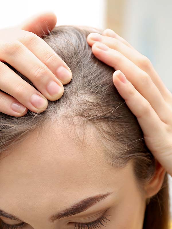 Perdita di capelli donne