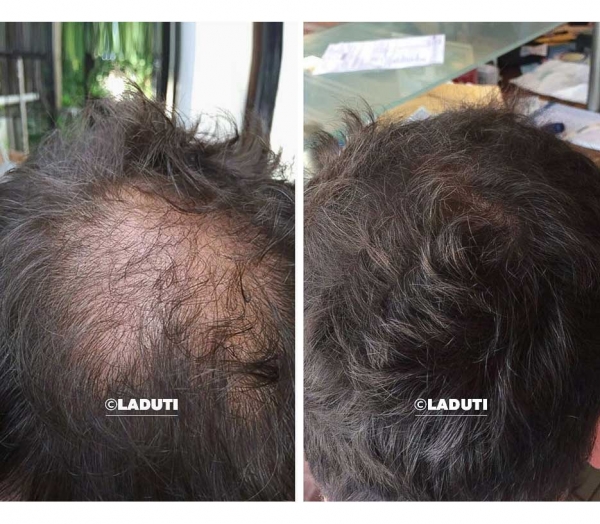 Haarausfall Haarausfall-Frauen