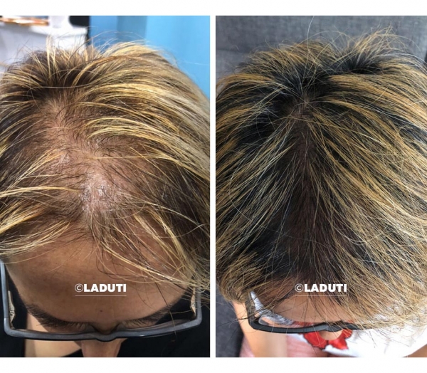Haarausfall Haarausfall-Frauen