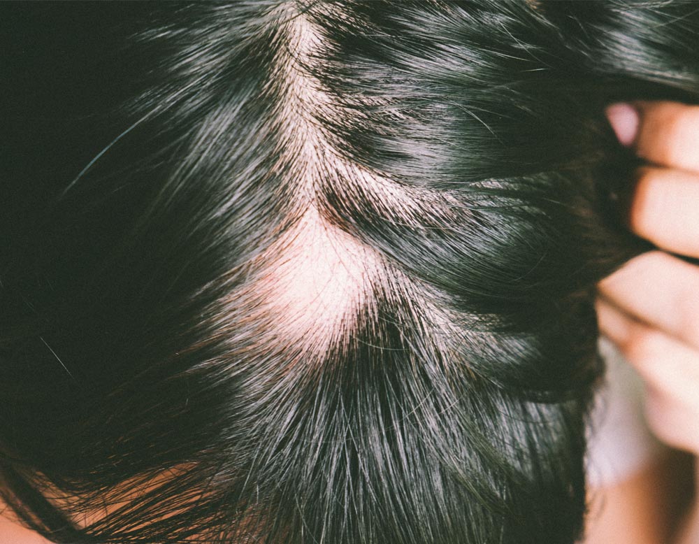 Circular hair loss: causes, symptoms and treatment